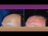 Hair Transplant